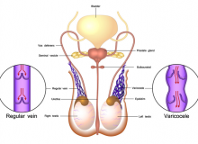 Những điều cơ bản cần biết về giãn tĩnh mạch thừng tinh(VARICOCELE)